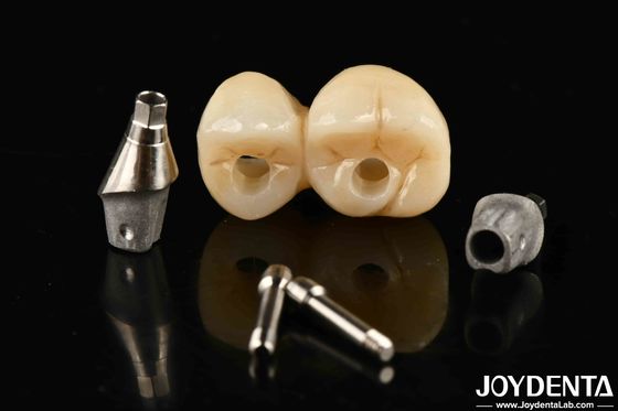 Implante dental de porcelana personalizável com suporte de ponte e coroa para uma estética excepcional