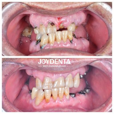 Resistente ao desgaste e à deformação Coroas dentárias de zircônia Duráveis e adequadas para restaurações posteriores e anteriores