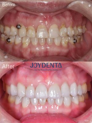 Restauração Oral por Veneer de Porcelana