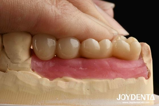 Processamento de ultra-precisão Implantes de zircônio com projeto assistido por IA e piercing gengival biônico para coroa integrada de zircônio
