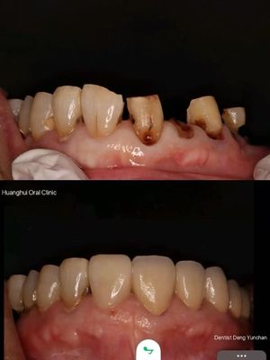 Coroas de Zirconia Premium para Laboratórios Dentários Globais.