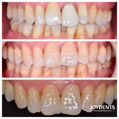 Coroas de Zircônio Premium | Terceirização Global de Laboratório Odontológico | JOY Dental Lab