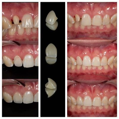 Laboratório de Fabricação de Coroas Dentárias de Zircônia | Terceirização de Coroas de Precisão - Joydentalab