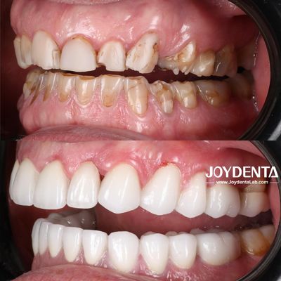 Soluções Premium em Coroas Dentárias de Zircônia | JOY Dental Lab