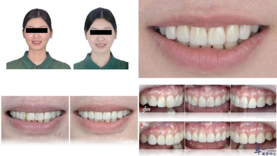 Produtos populares da Joydentalab: Veneers estéticos simulados