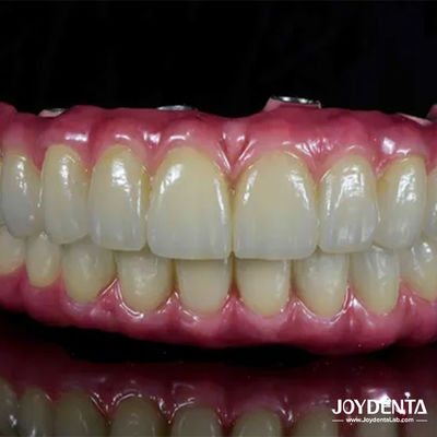 Ponte híbrida de titânio leve para restauração dentária