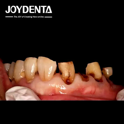 Coroas de Zirconia Premium para Laboratórios Dentários Globais.