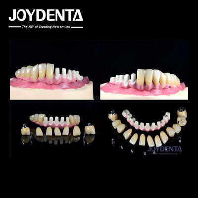 Implantes dentários endossiais múltiplos Conexão interna para restauração de arco completo