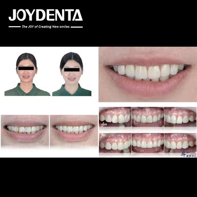 Produtos populares da Joydentalab: Veneers estéticos simulados
