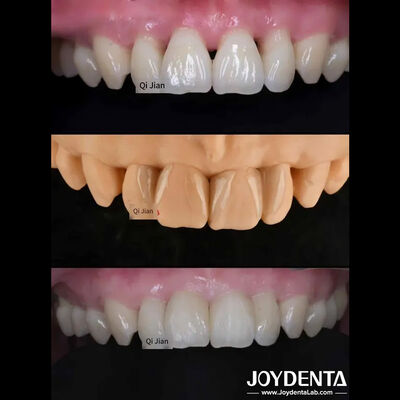 As folhas de gafanhoto são a solução perfeita para folhas dentárias translúcidas naturais