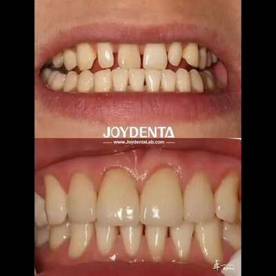 Veneers Dentários Duráveis Sem Descoloração Perfeito Para Necessidades de Sourcing B2B E Mais