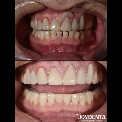 Forma natural Cosmética Odontologia Veneers de porcelana, Dental Cosméticos Veneers de porcelana