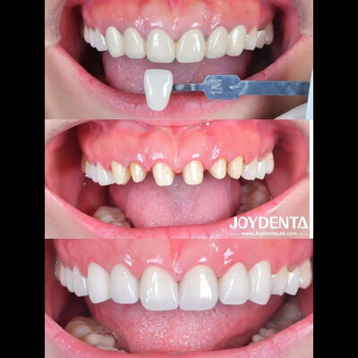 Estudo de Caso de Coroa Dentária de Zircônia | Outsourcing de Laboratório Global - Joydentalab