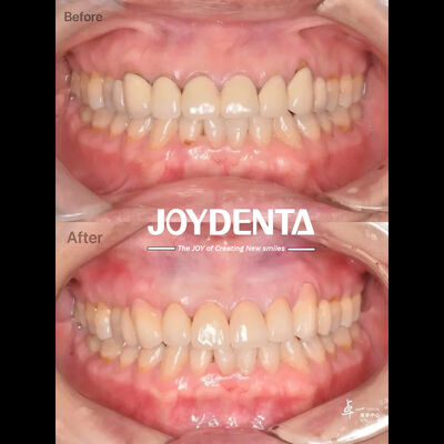 Zircônia Dentária Para Tecido Oral Seguro e Compatibilidade CAD/CAM