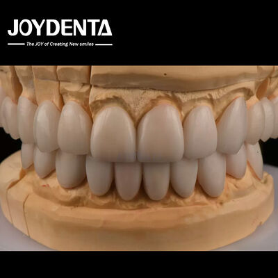 0.3mm Espessura Ips Emax Veneers Veneers Cerâmicas Anterior Restaurações Posteriores