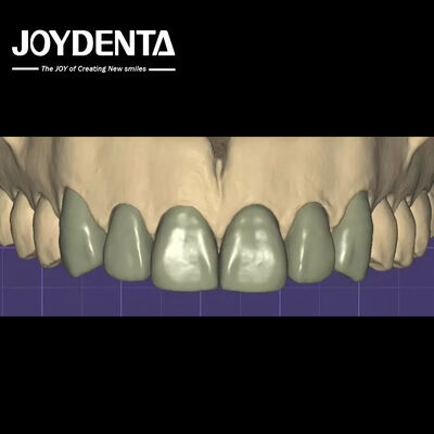 Impressão 3D Virtual Digital Wax Up Compatibilidade perfeita com outros softwares dentários